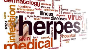 How Do You Manage A Herpes Infection In A Long-Term Relationship?